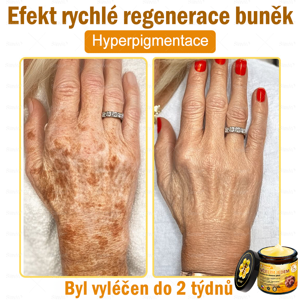 🧑‍⚕️Doporučení dermatologa 🐝 Sinvie® Krém na obnovu pleti s včelím jedem 🔥 Proti vráskám, pigmentovým skvrnám a ochablé pokožce – 50 ml